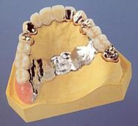 Modellgussprothese_clip_image001.jpg